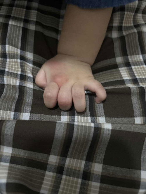 Tangan dan telapak kaki merah