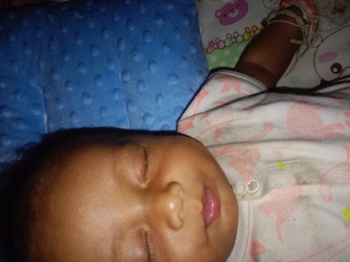 เป็นขี้ตาเหลือง