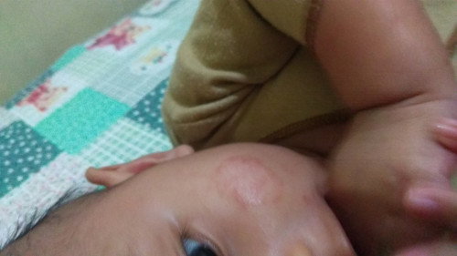 Solusi untuk pipi merah yang tak kunjung sembuh