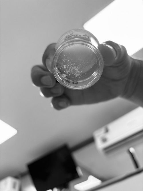 ฉี่มีตะกอน มีก้อนแบบนี้ใครเคยเป็น