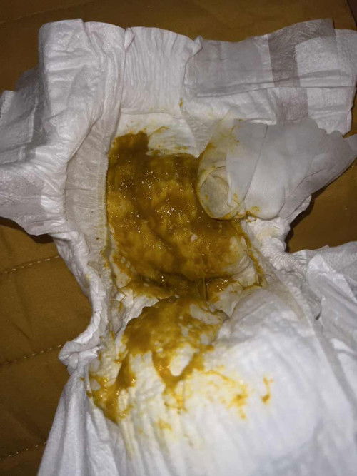 น้องถ่ายเหลวเหนียวเป็นสีส้มเข้ม