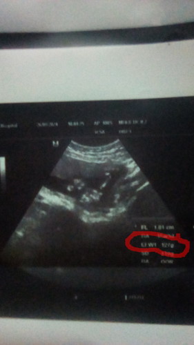 อยากรู้ตัวแปลในใบอัลตราซาว