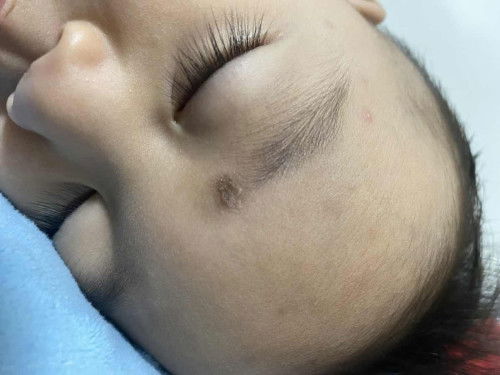 สะเก็ดที่คิ้วคืออะไร