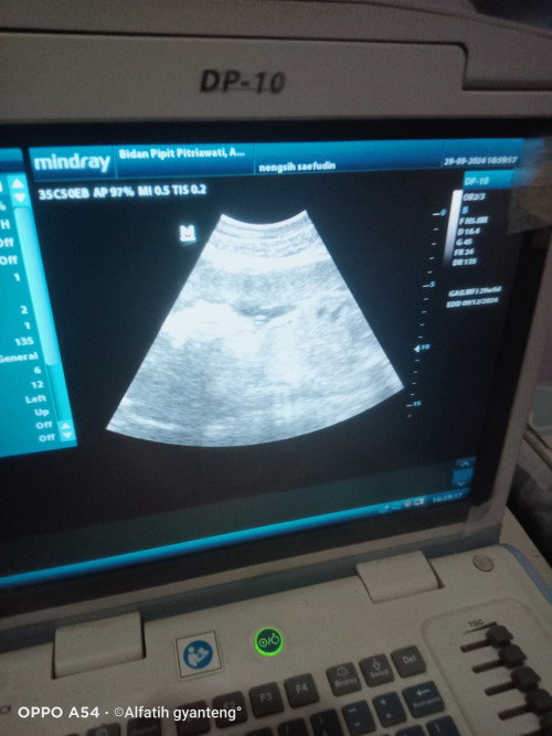 Bagaimana mengatasi hamil sungsang, padahal di usia 20minggu kpla bayi sudah dibawa skrg 31minggu