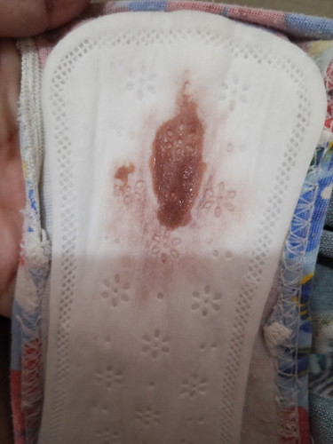 Miscarriage