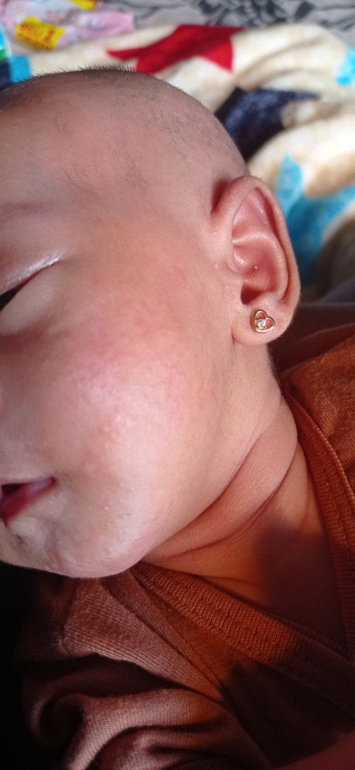 Bruntusan di muka bayi