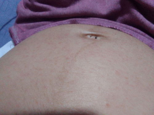 Normal po ba sa buntis ang mag karoon na parang mga butil-butil na kulay pula maliliit sa katawan?