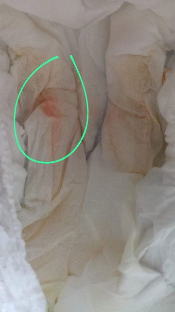 bercak oranye ke pink2 an pada bayi perempuan usia 3,5bulan,