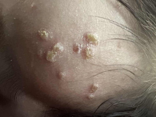 Skin rashes ni baby