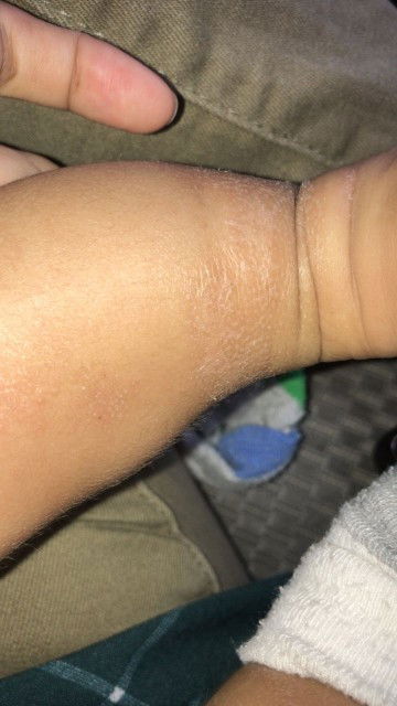 Kaki baby mengelupas