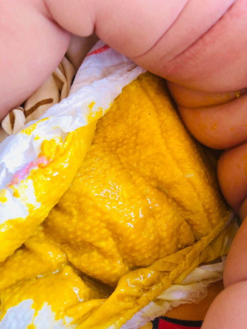 ถ่ายเเบบนี้ท้องเสียไหมคะ