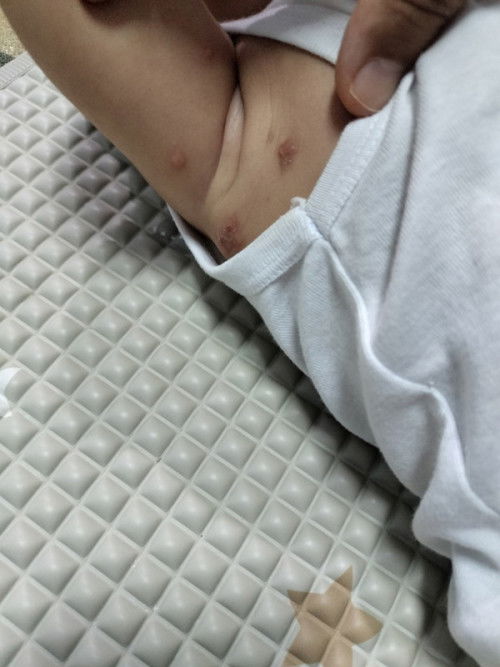 Benjolan seperti bisul bawah ketiak