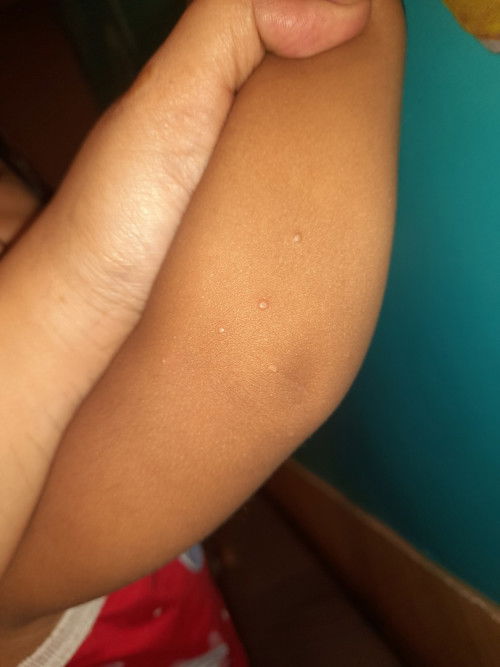 Butlig butlig sa katawan ni baby