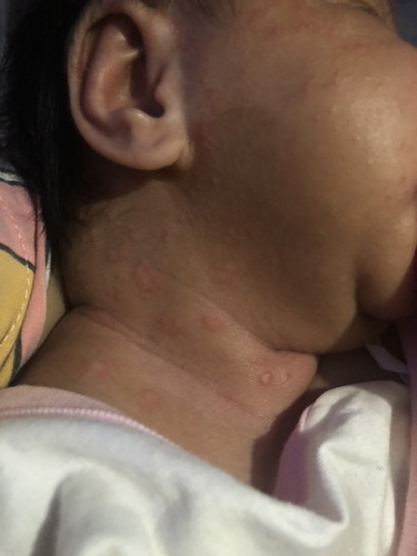 Neck Rashes