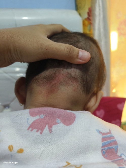 Kulit kepala bayi merah