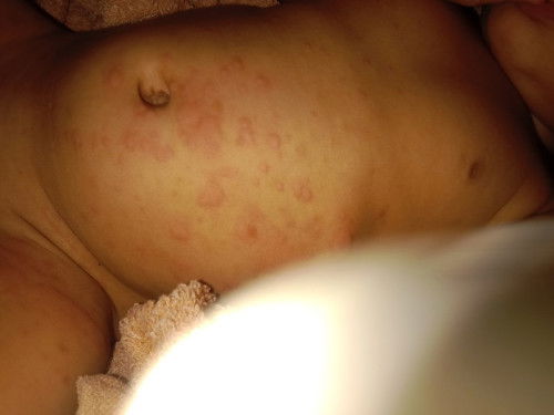 ผื่นอะไรค่ะแม่ๆ