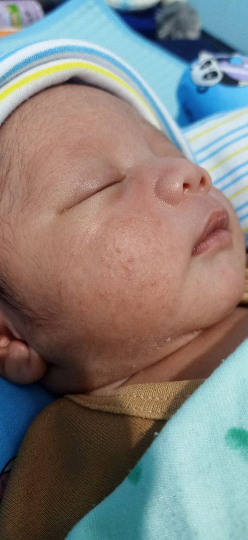 Bintik merah di pipi bayi newborn