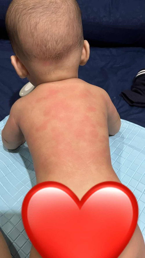 Ini reaksi alergi bukan?