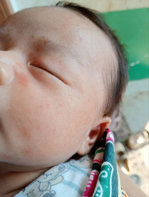 Bintik merah di kulit bayi