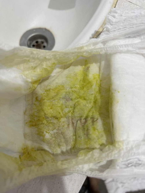 Baby 1 tahun, 1 minggu cirit birot after ambil ubat cacing provided by KK