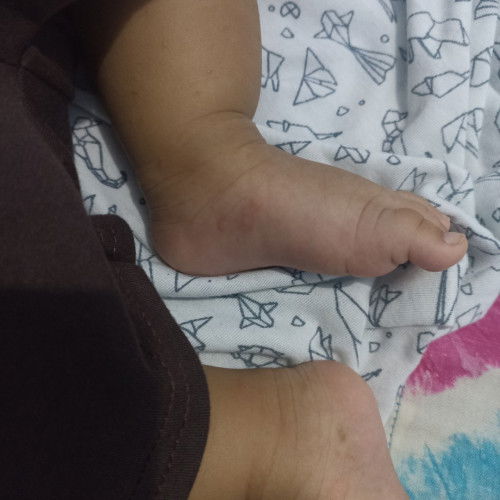 Ke Dokter Spesialis Anak atau ke Dokter Spesialis Kukit