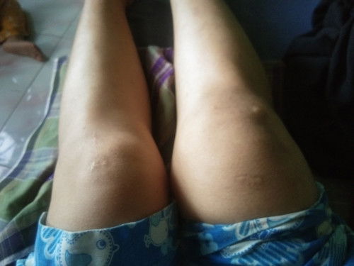 Bunda saya hamil 16 minggu tapi telapak kaki bengkak dengkul nya sama jari tangan bengkak juga