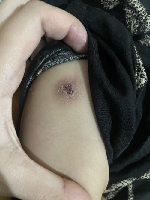 bisul bcg hasilnya jadi koreng