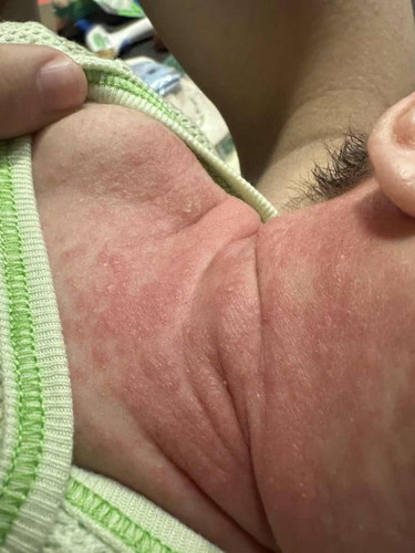 Help, red patch rashes on my 1 month old. Do anyone knows what is this? and how can I help my lo?