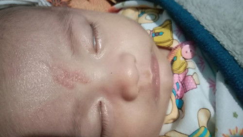 Kemerahan pada kulit