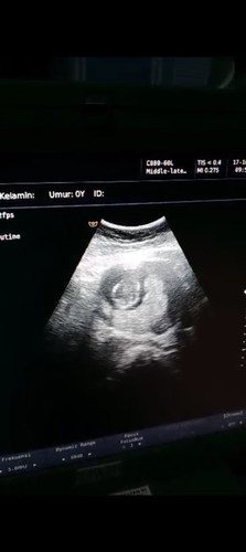Usg 14 minggu apakah yg dibawah itu plasenta?