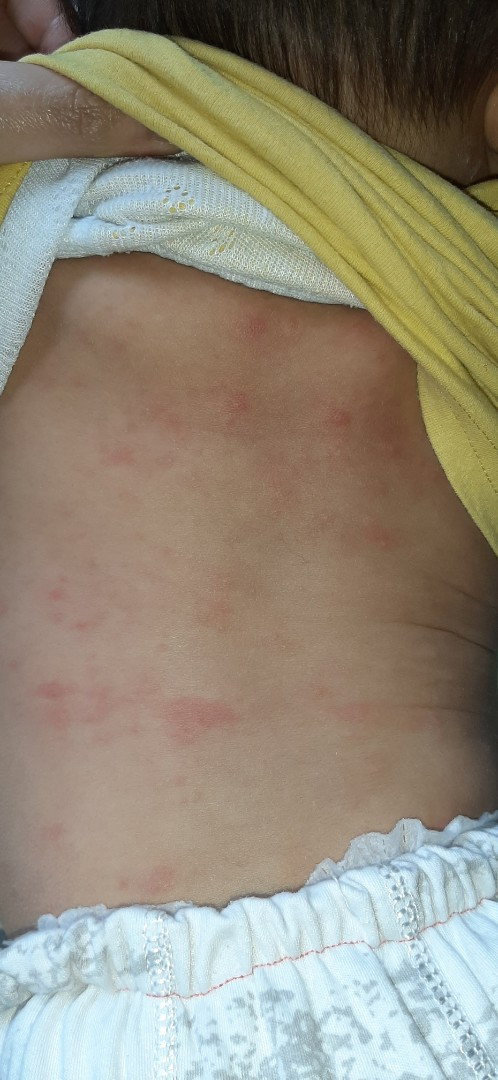 Bentol merah di badan bayi