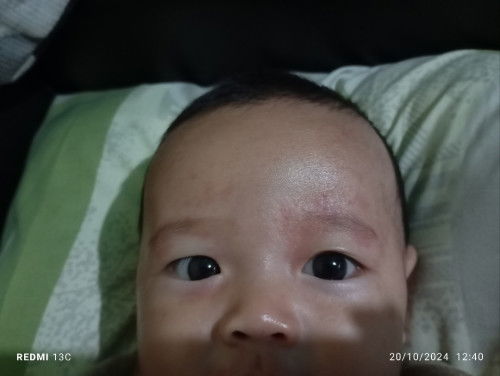 alergi / iritasi kulit merah tiba tiba