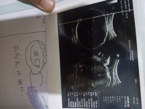 hasil USG