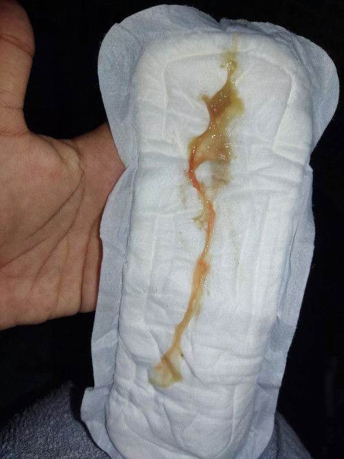 Mucus plug na ba ito?