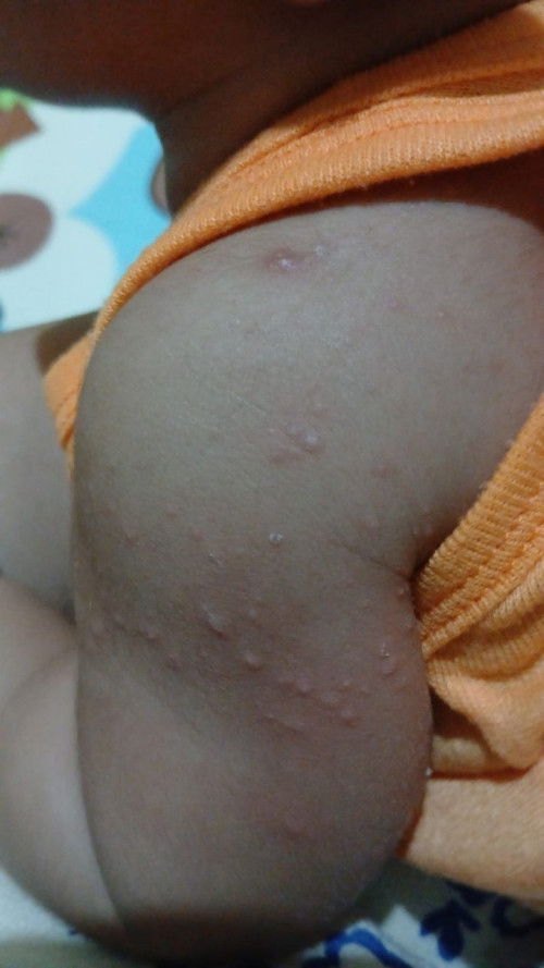 bun ini kenapa ya , udah puskesmas rs besar udah ke dsa juga salep udh jg kerig tp nimbul lg