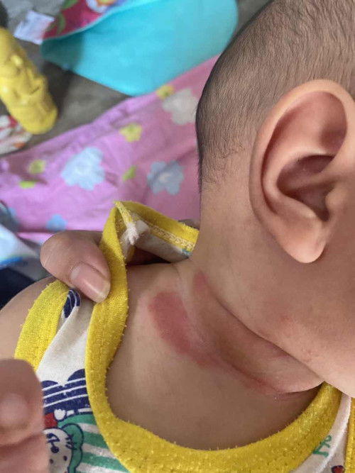 ผื่นแพ้เหงื่อค่ะ