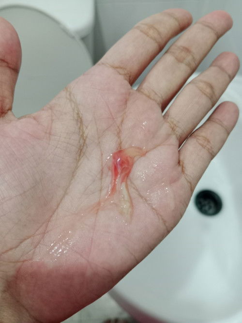 ไปหาหมอมาปากมดลูกเปิด2เซน แต่หมอให้กลับมาดูอาการต่อที่บ้าน มีมูกแต่ไม่เจ็บท้อง ใกล้คลอดแร้วใช่ไหม