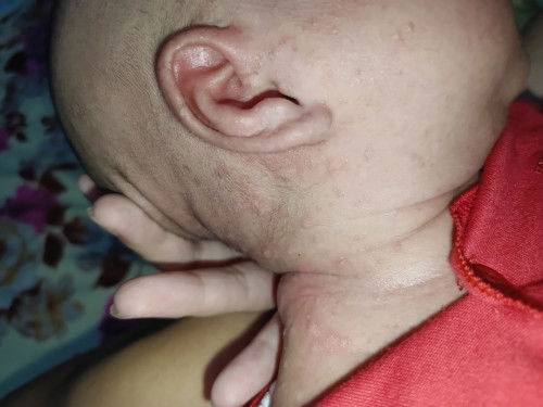 Bintik di leher&mukA