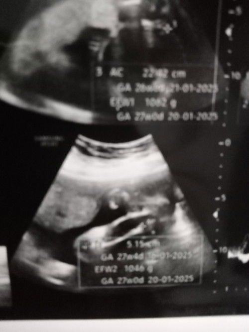 Jenis kelamin lewat usg