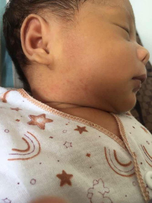 Bintik merah pada bayi