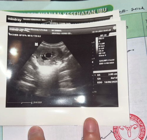 usg tdk sesuai hpht terancam tidak berkembang