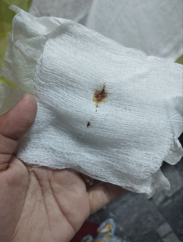 infected cs wound ?