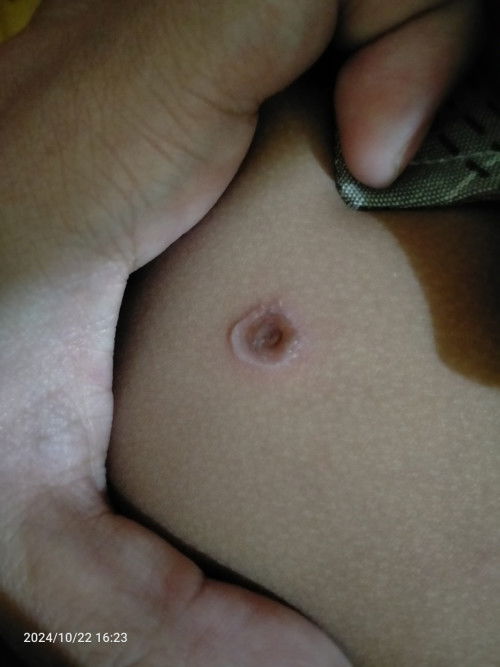 Halo bun..
Apakah ada bun yang anknya pernah kyk gini?