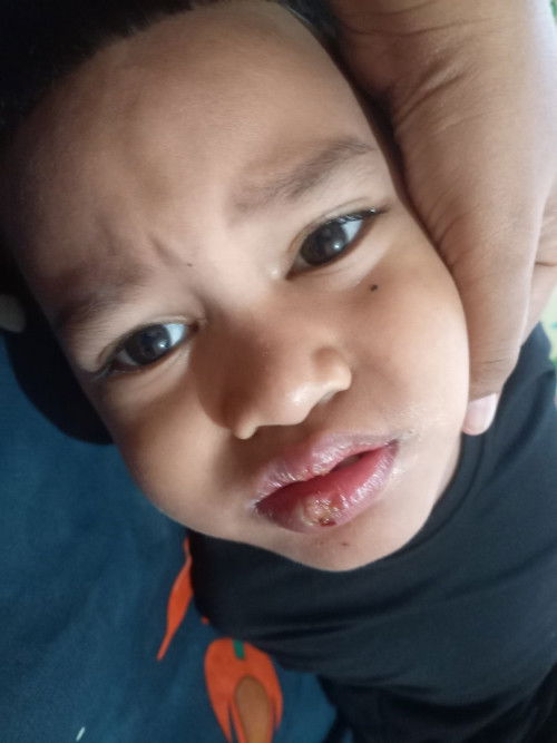 Sariawan pada anak 4 tahun