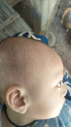 Bintik merah banyak di area dahi / kepala bayi