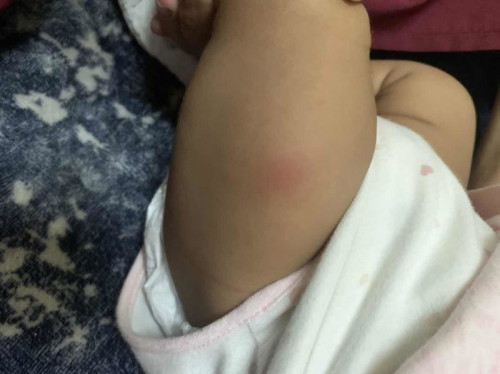 Normal ke tempat cocok baby (2bln) kat paha merah dan rasa keras