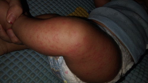 ALERGI MINYAK URUT BIDAN