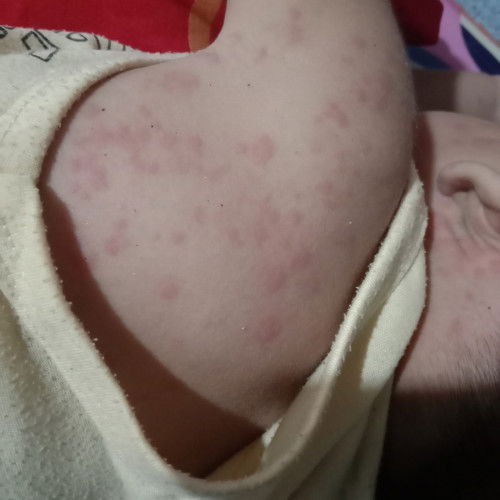 Ruamnya hilang timbul