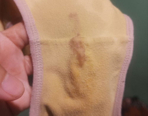 Flek coklat di kehamilan 8minggu