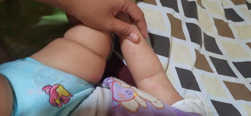 Bintik merah pada kulit bayi